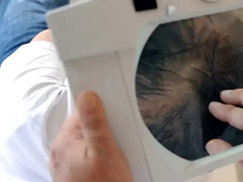 İstanbul’da Şok Olay: Saç Ekimi Sonrası Genç Adam Hayatını Kaybetti